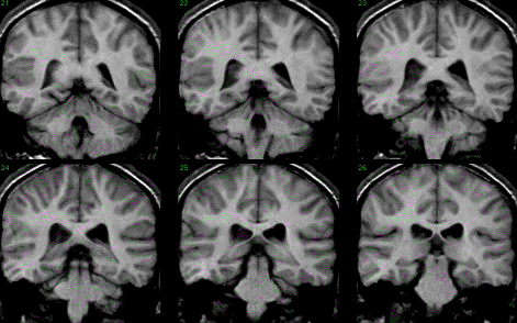 coronal brain slices,www.cma.mgh.harvard.edu